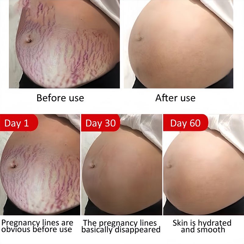 Original 120G Stretch Mark Cream Penghilang Strechmark Cream Penghilang Strechmark Obat Strechmark