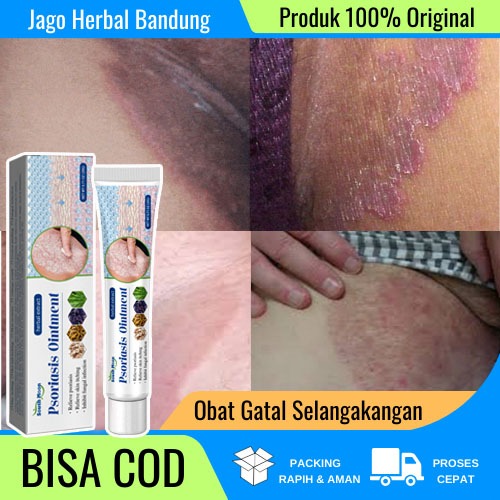 salep gatal paling ampuh salep gatal obat gatal selangkangan obat selangkangan gatal dan hitam obat 