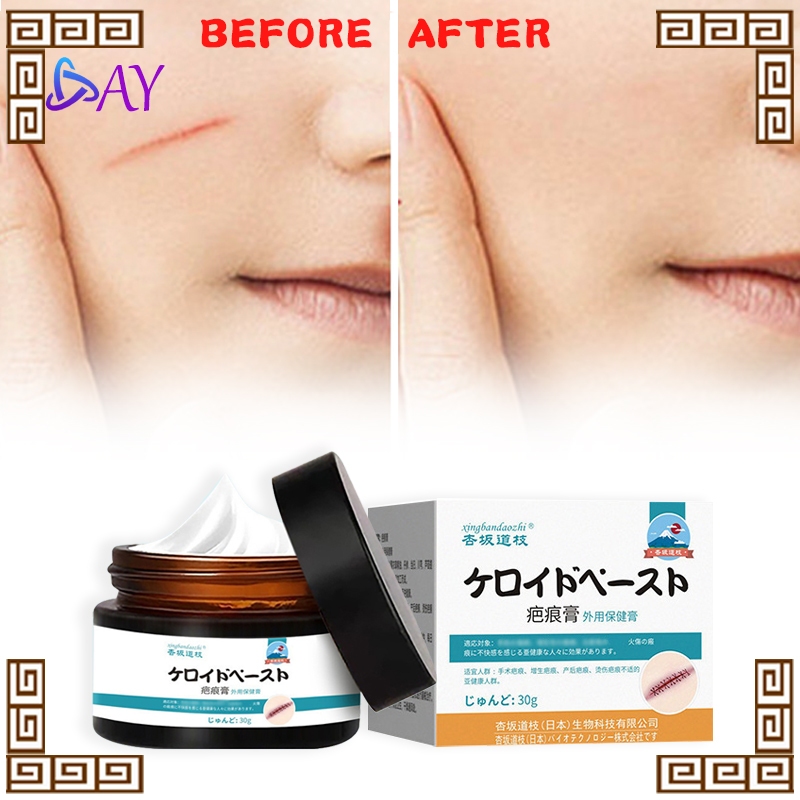 Penghilang Bekas Luka Bekas Gigitan Nyamuk  Bekas Luka Tua Penghapu Ampuh Menghilangkan Bekas Luka