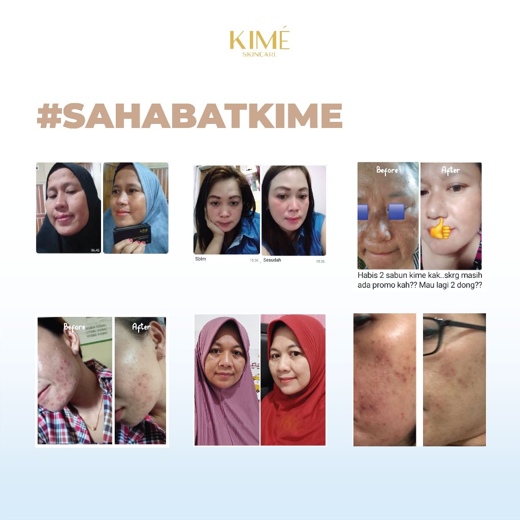 Sabun Cuci Muka Kime - Penghilang Flek Hitam