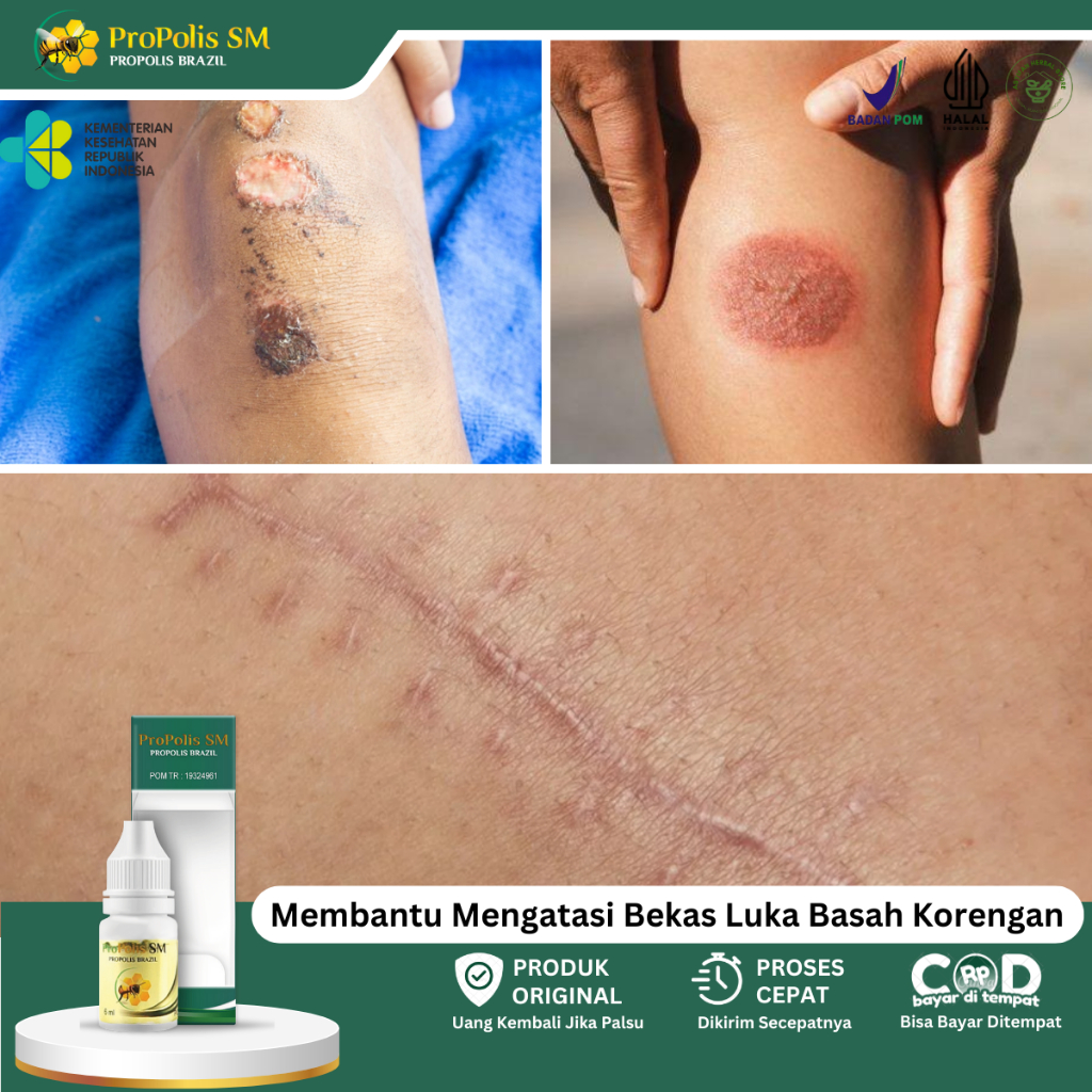 Obat Penghilang Luka, Obat Infeksi Luka, Obat Luka Basah, Obat Pencegah Infeksi, Obat Bekas Luka, Ob