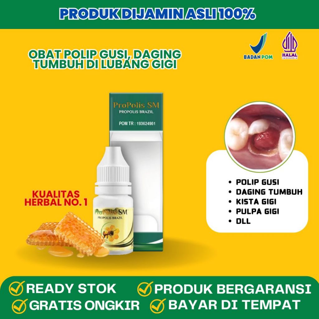 Obat Polip Gigi, Daging Tumbuh Di Lubang Gigi, Pulpa Gusi,Kista Gigi Herbal Propolis SM
