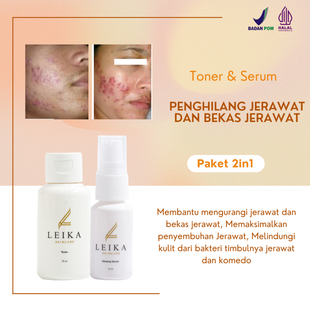 PAKET 2in1 [TONER & SERUM] Penghilang Jerawat Penghilang Bekas Jerawat Penghilang Jerawat Dan Bruntu