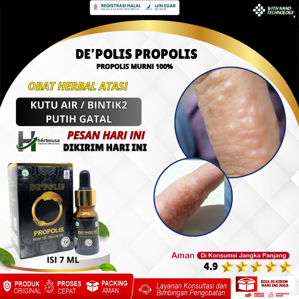Obat Bintik Berair, Obat Kutu Air, Kutu Air Untuk Kaki, Kutu Air Tangan, Salep Kutu Air, Gatal Berai