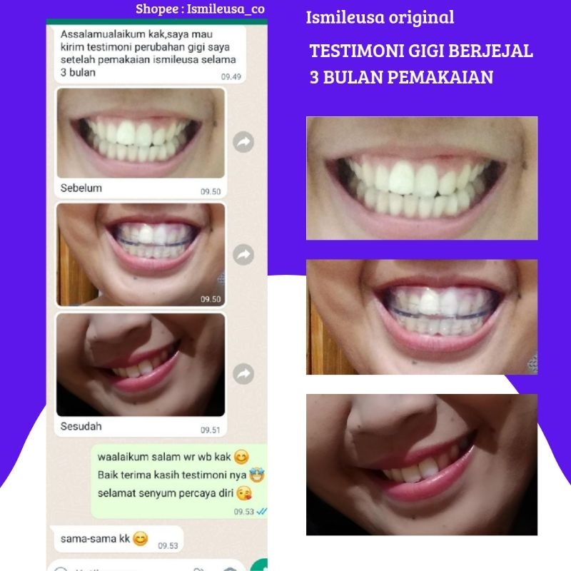 IsmileUSA / Perapih Gigi /Teeth Trainer /Alignment /Aligner /Perapih Gigi Original