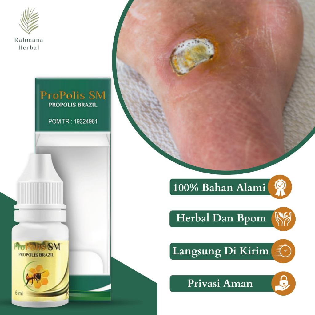 Obat  Luka Diabetes, Obat Pengering Luka Diabetes, Obat Oles Luka Diabetes Basah, Obat Luka Diabetes