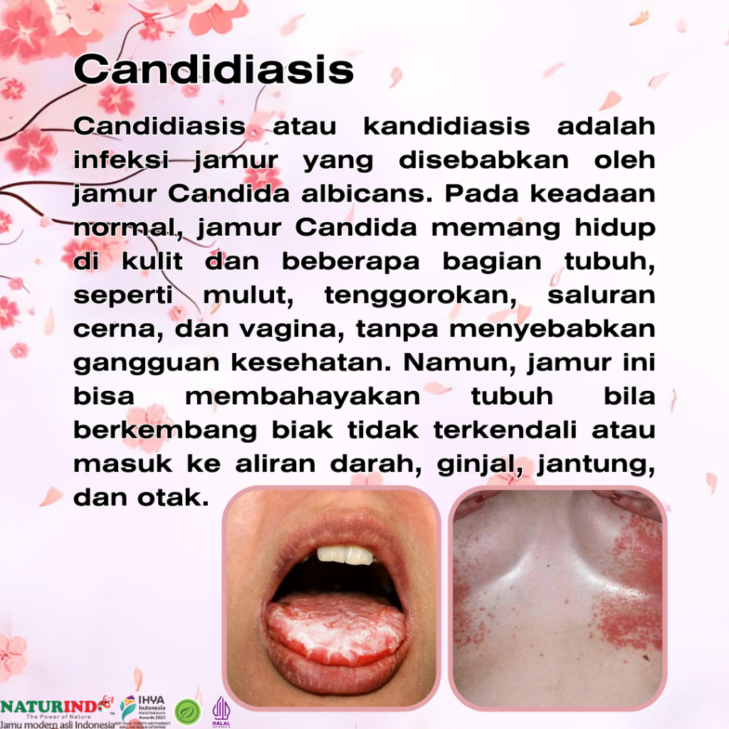 Obat Candidiasis Herbal Candidias Gatal Kulit Kelamin