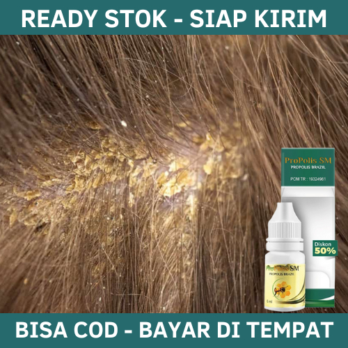 Obat Ketombe Berkerak Di Kepala - Obat Ketombe Parah Berkerak - Obat Ketombe Yang Membandel - Obat K