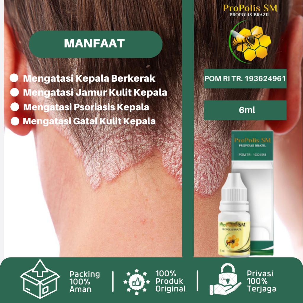 Obat Kerak Kepala, Obat Ketombe Kerak Kulit Kepala, Obat Kepala Ketombe Jamur, Obat Jamur Kepala Dew