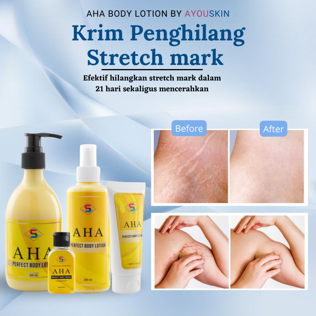 Cream / Krim Penghilang Stretch mark, Menghilangkan Stretch Mark atau Guratan Putih Di Perut, Lengan