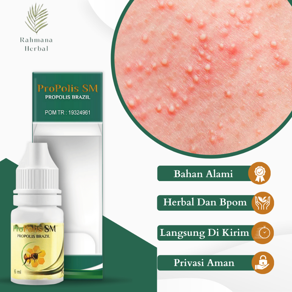 Obat Gatal Biang Keringat, Obat Ruam Gatal Keringat, Obat Bintik Bintik Merah Di Kulit, Obat Kulit G