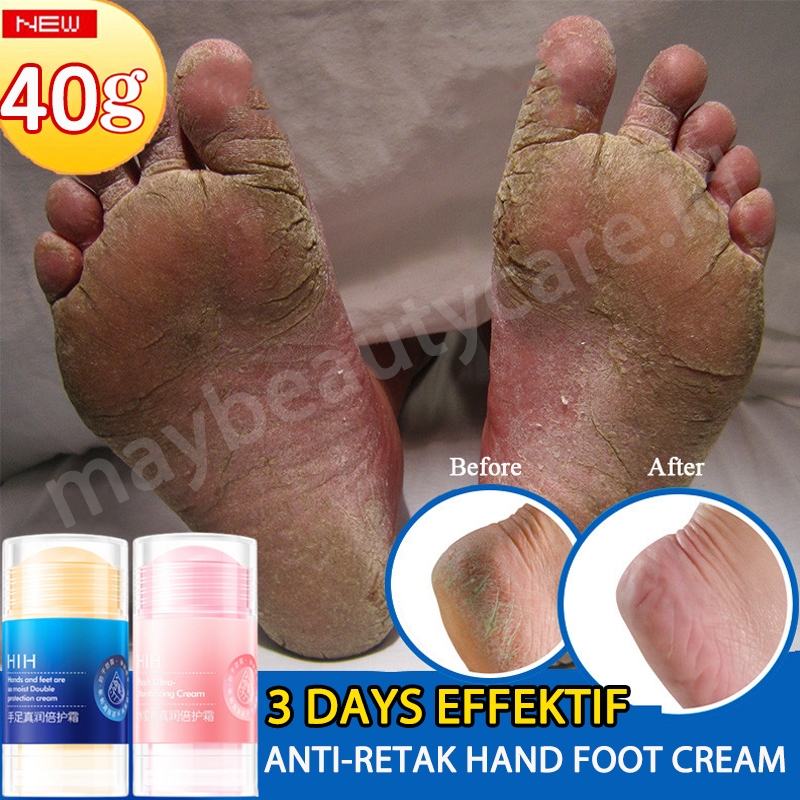 Obat Tumit Kaki Pecah Dan Kering Dan Kasar Ampuh 100% Original HIH Ultra Pelembab Tumit Kaki Dan Tan