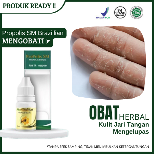 Obat Kulit Jari Tangan Mengelupas, Telapak Tangan Mengelupas Kasar Kering & Pecah Pecah