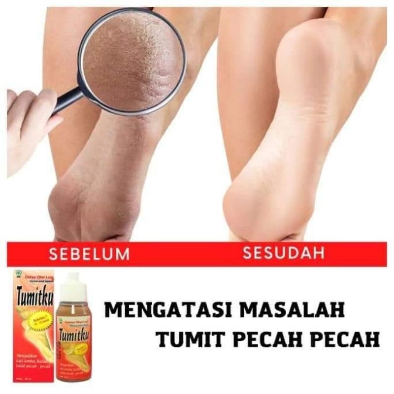 Tumitku Penghilang Kulit Tumit Pecah Pecah