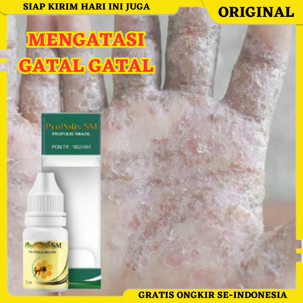 Propolis SM, Obat Gatal, Obat Gatal di Tangan, Obat Gatal di Kaki, Obat Penghilang Gatal, Obat Gatal