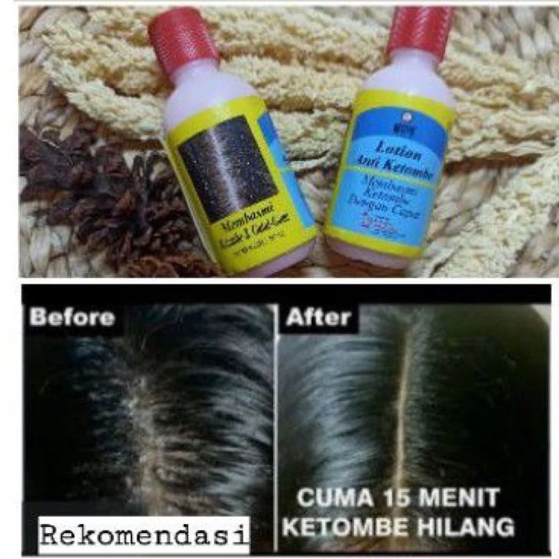 SSS Penghilang Pembasmi Ketombe Di Kepala Dengan Cepat / Obat Ketombe Ampuh / Lotion Anti Ketombe