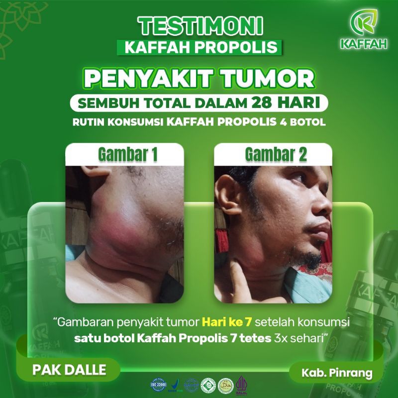 KAFFAH PROPOLIS AMPUH MENGATASI TUMOR BIIDZNILLAH