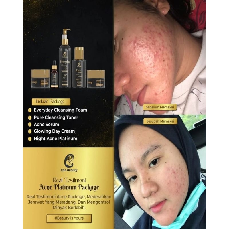 Paket Acne Can beauty
