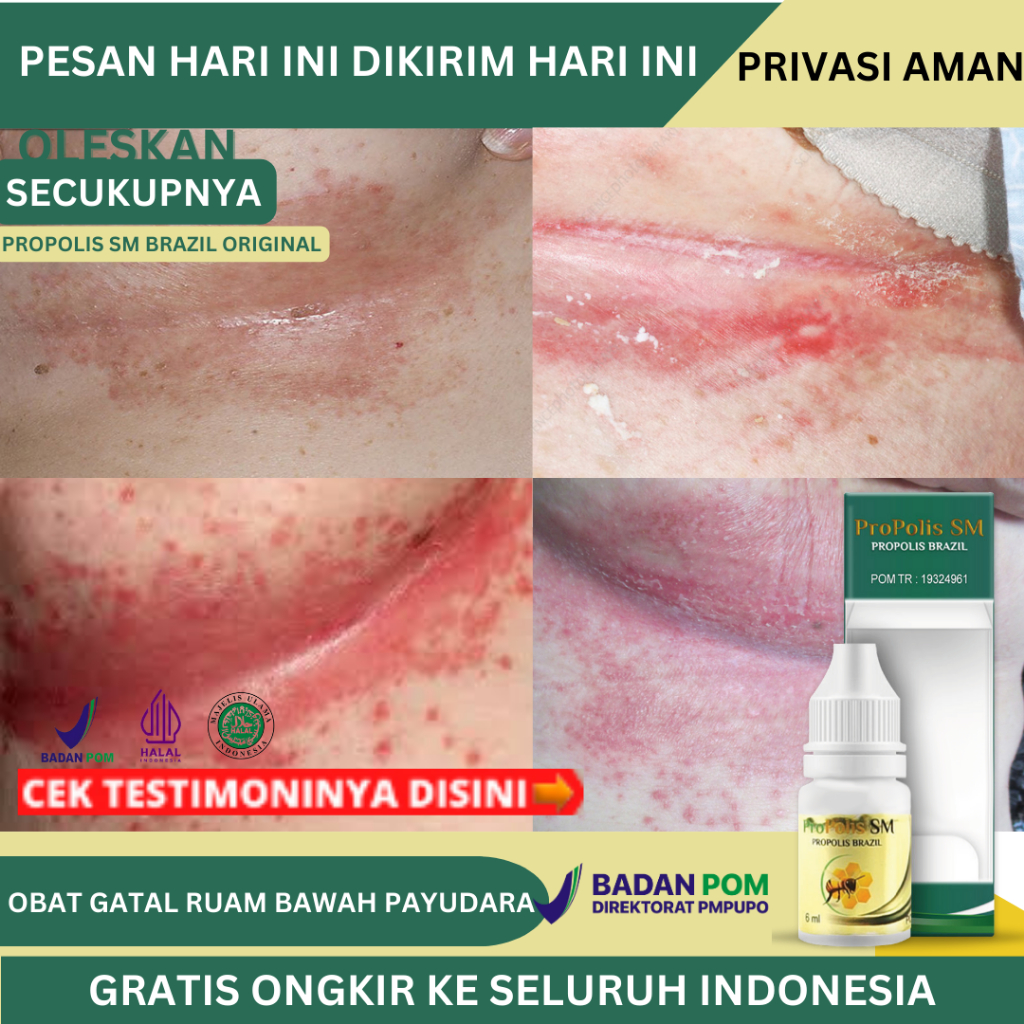 Obat Gatal Lipatan Payudara, Obat Ruam Lipatan Payudara, Obat Payudara Gatal, Panas, Perih, Ruam Mer
