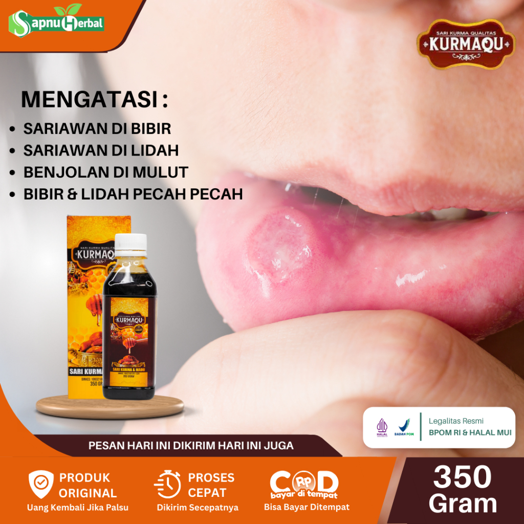 Obat Sariawan di Mulut, Sariawan Lidah, Bibir dan Lidah Pecah Pecah, Sariawan Akut, Sariawan Parah, 
