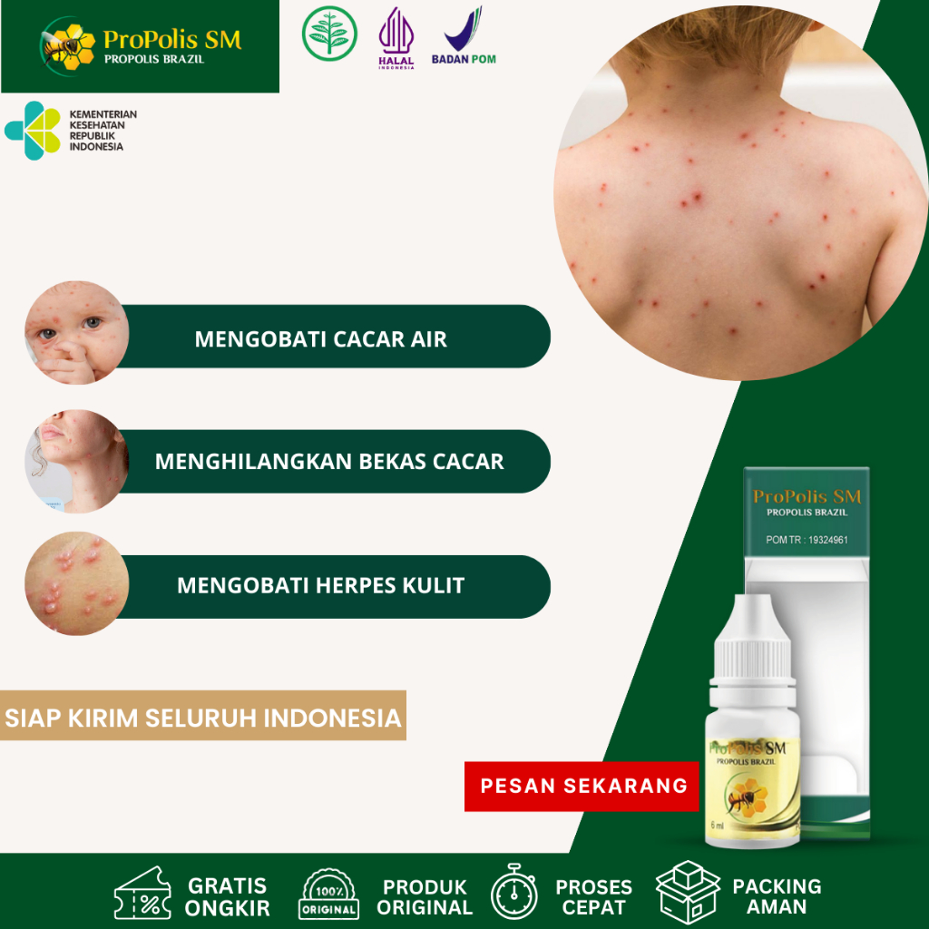 Obat Cacar Air, Obat Penghilang Bekas Cacar, Obat Penghilang Cacar, Obat Cacar Api, Obat Gatal Cacar