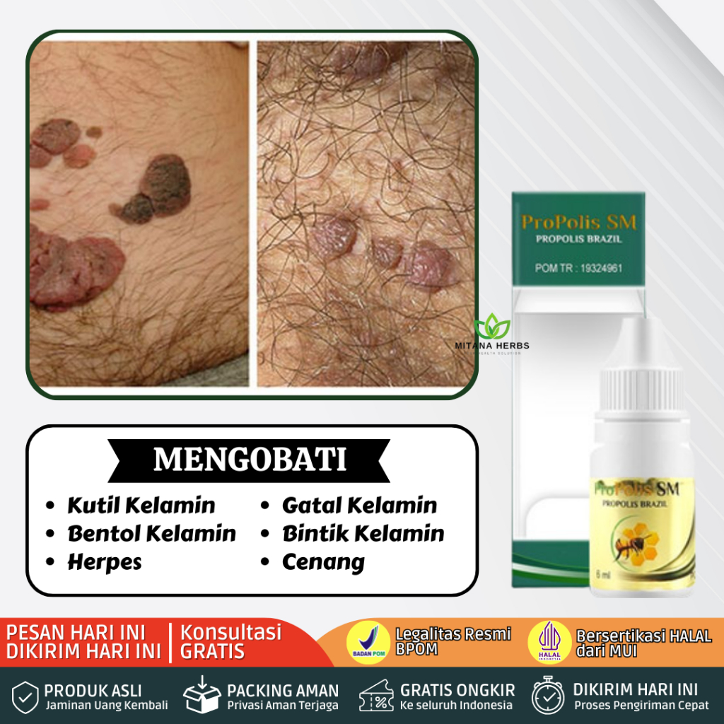 Obat Kutil Kelamin HPV, Obat Kutil Kelamin Pria / Wanita, Obat Gatal Kelamin, Obat Penghilang Kutil 