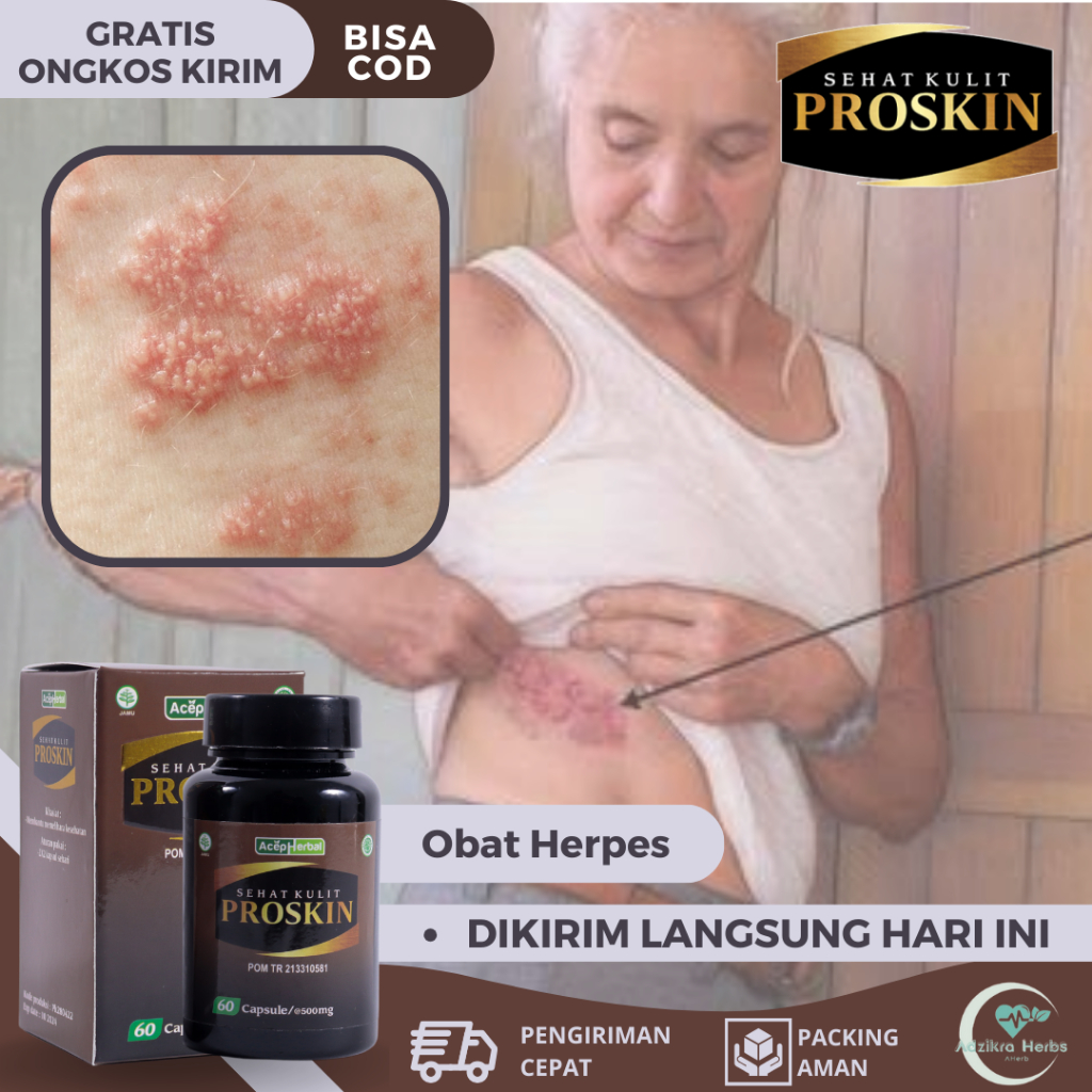 Obat Herpes, Obat Herpes Zoster, Obat Gatal Kulit Herpes, Obat Herpes Kelamin, Obat Luka Herpes, Oba