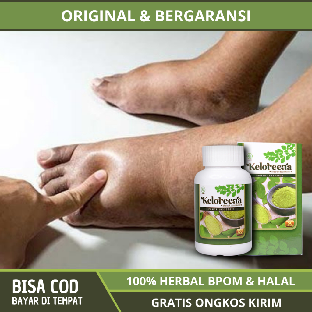 Obat Kaki Bengkak Karena Gula / Diabetes, Asam Urat, Ginjal, Jantung, Obat Edema Kaki Bengkak, Obat 