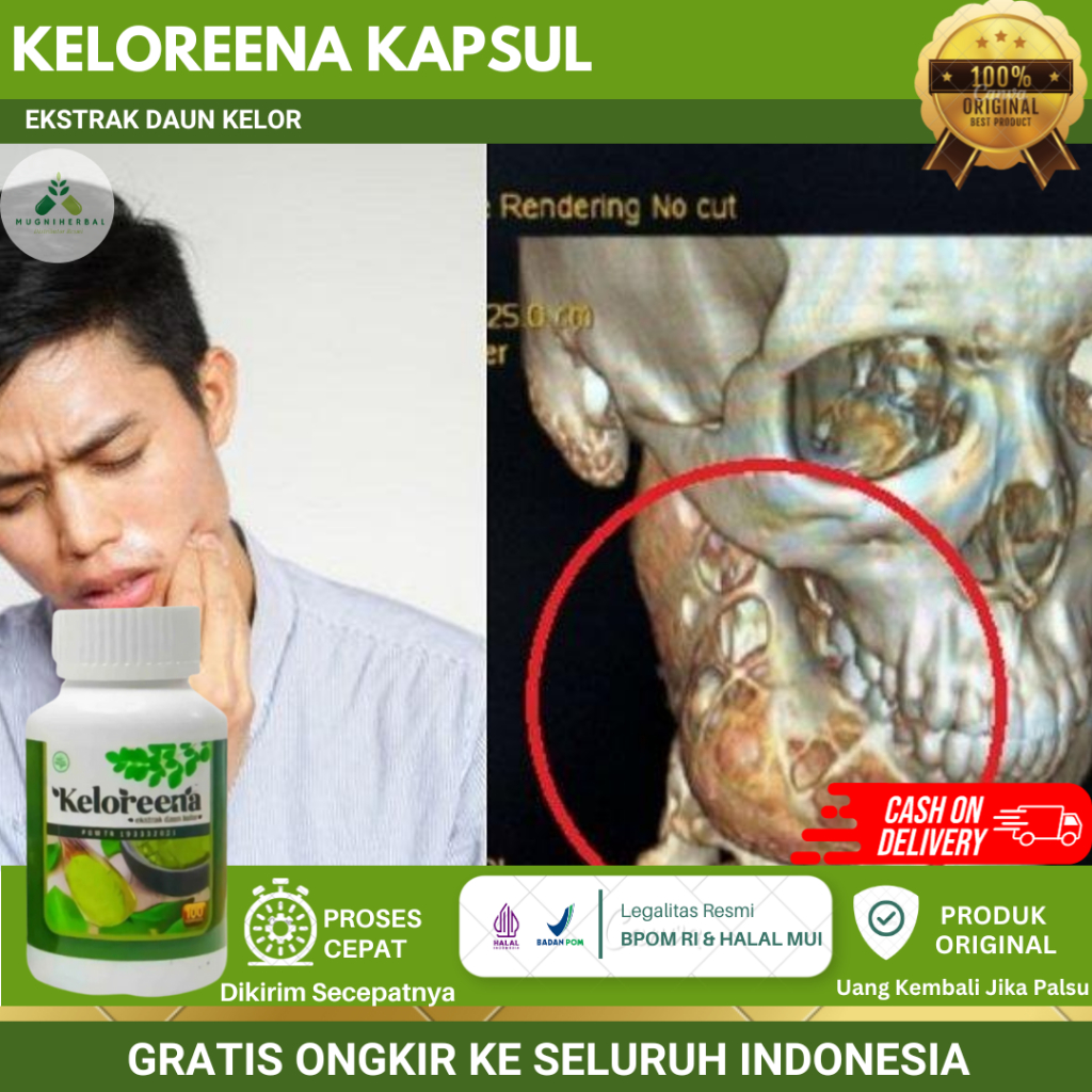 Keloreena Kapsul 100% Original - Obat Tumor Rahang Bengkak, Benjolan Gusi Dalam Mulut, Kanker Rahang