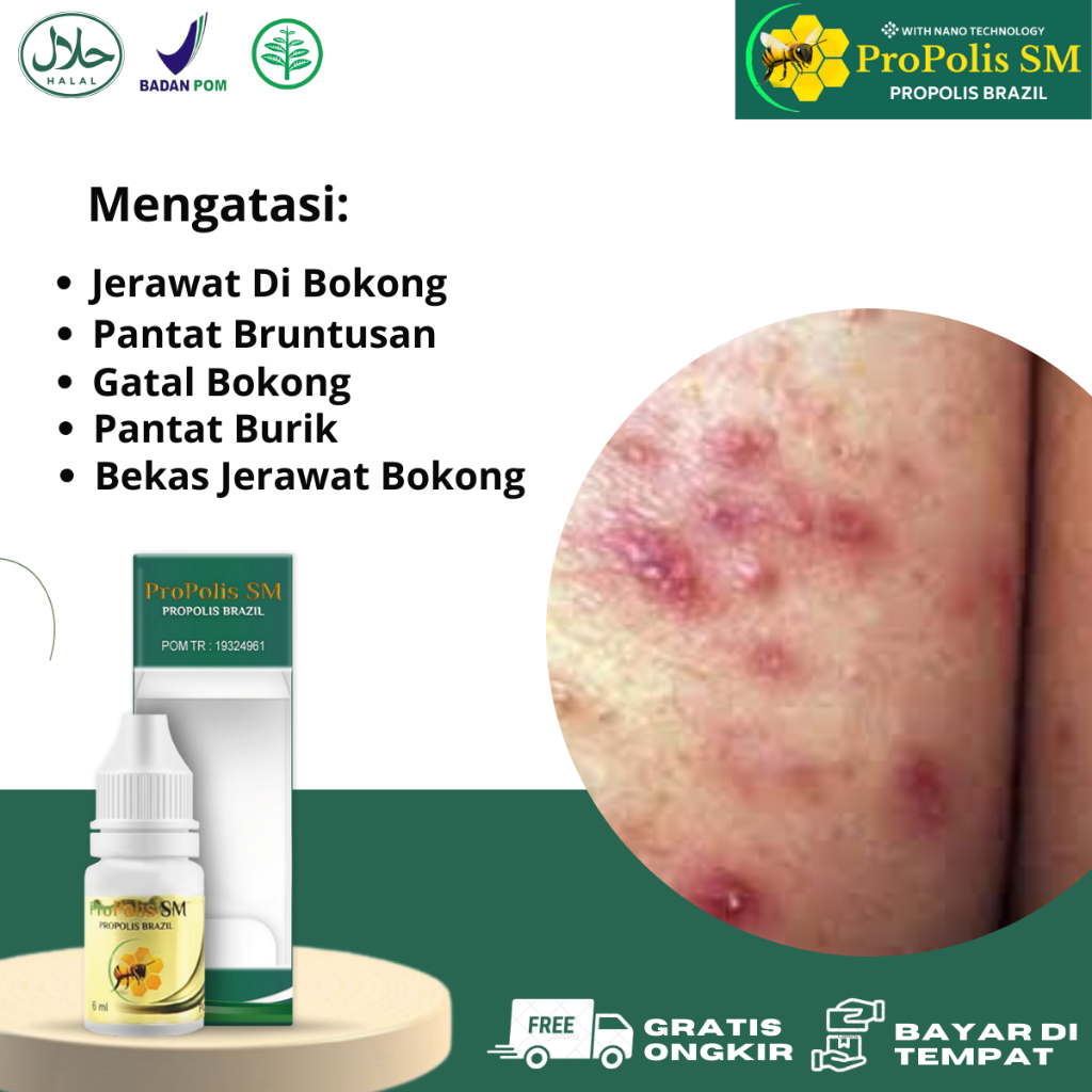 Obat Jerawat Bokong, Obat Pantat Bruntusan, Obat Jerawat Pantat, Salep Jerawat Bokong, Obat Bokong H