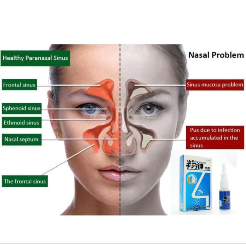 Nasal Spray Rhinitis Nose Spray Sinusitis Nasal alat terapi Sinus Sinusitis Rhinitis Hidung Pilek Ob