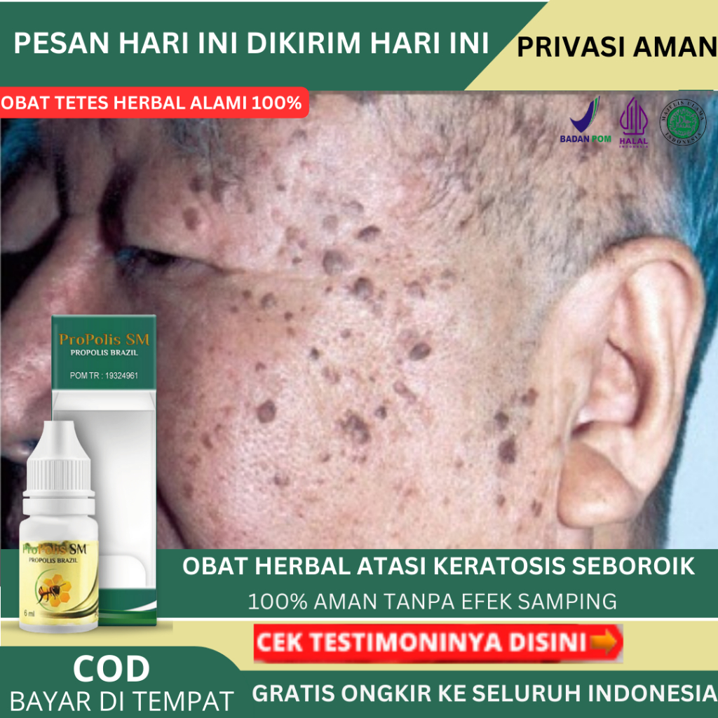 Obat Penghilang Keratosis Seboroik Di Wajah, Bintik Hitam Di Kulit,  Kanker Kulit Melanoma, Benjolan