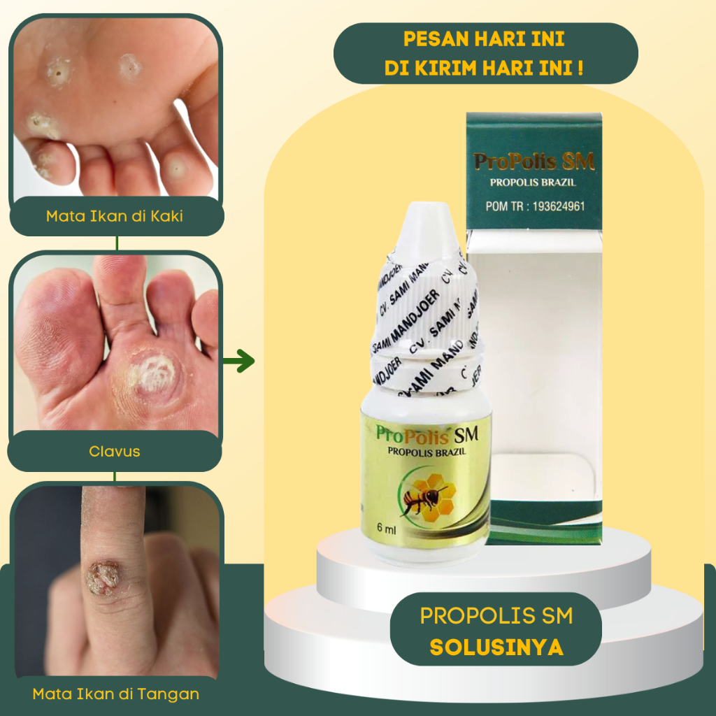 Obat Mata Ikan - Obat Oles Mata Ikan - No Plaster Mata Ikan - Obat Penghilang Mata Ikan - Perontok M