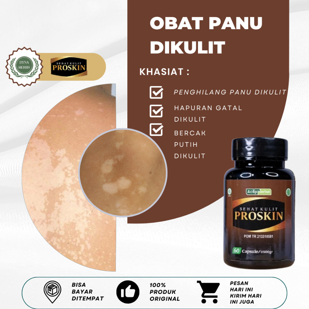 Obat Penghilang Panu, Obat Panu Anak, Obat Hapur Kulit, Obat Penghilang Panu di Badan di Wajah, Obat