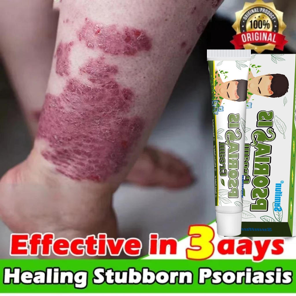 Obat psoriasis / pengobatan psoriasis / lumut saham / eksim / lumut kaki / salep anti gatal topikal 