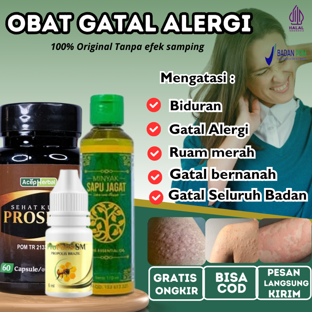 Salep Alergi Kulit, Obat Biduran Menahun, Obat Kaligata, Obat Kulit Gatal Gatal , Minyak oles  Alerg