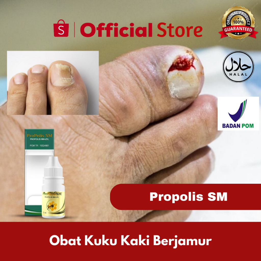 Obat Herbal Untuk Kuku Kaki Berjamur, Obat Kuku Tangan Rusak, Obat Tangan & Kaki Centengan, Obat Kap