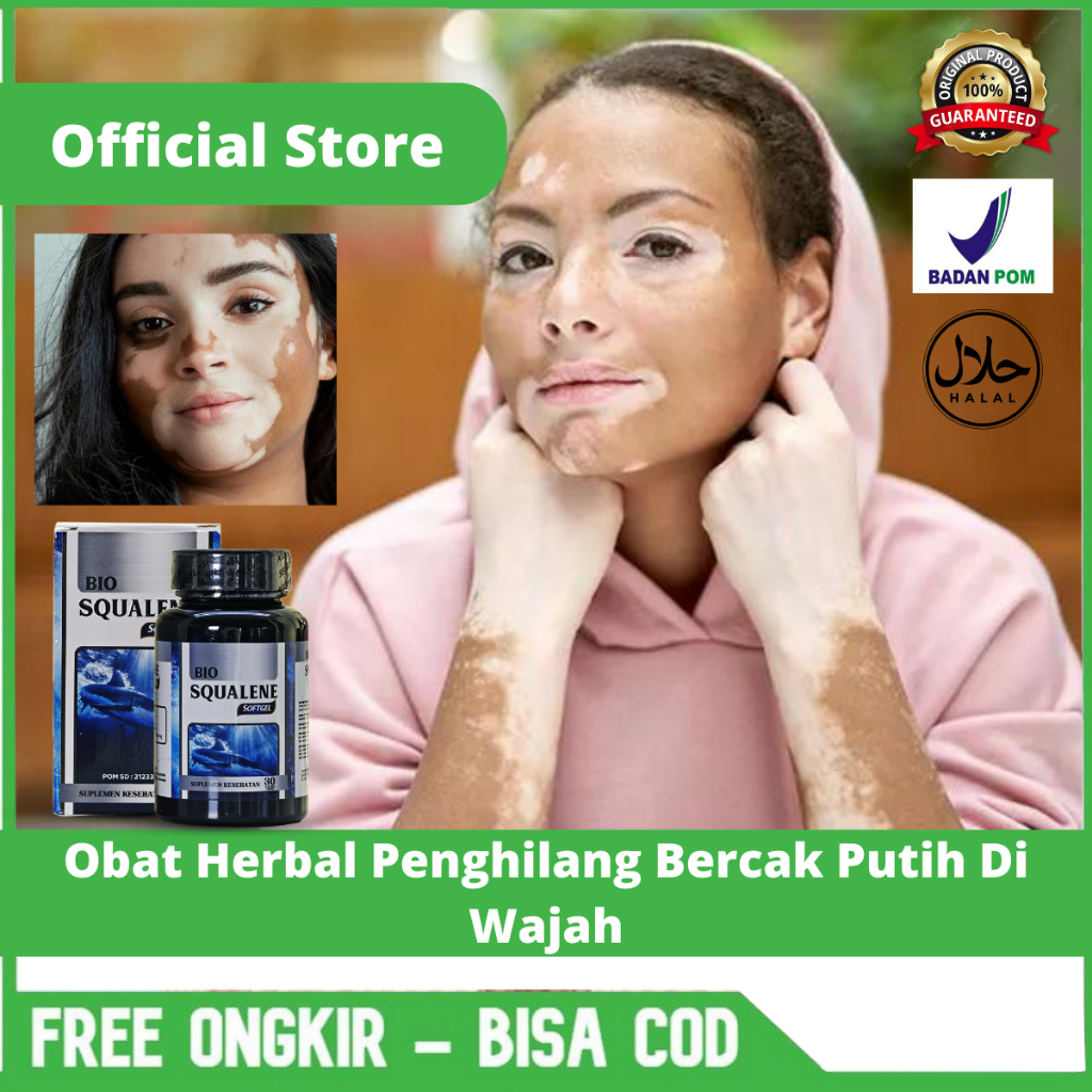 Obat Herbal Untuk Mengatasi Vitiligo, Obat Penghilang Vitiligo, Obat Herbal Penghilang Bercak Putih 
