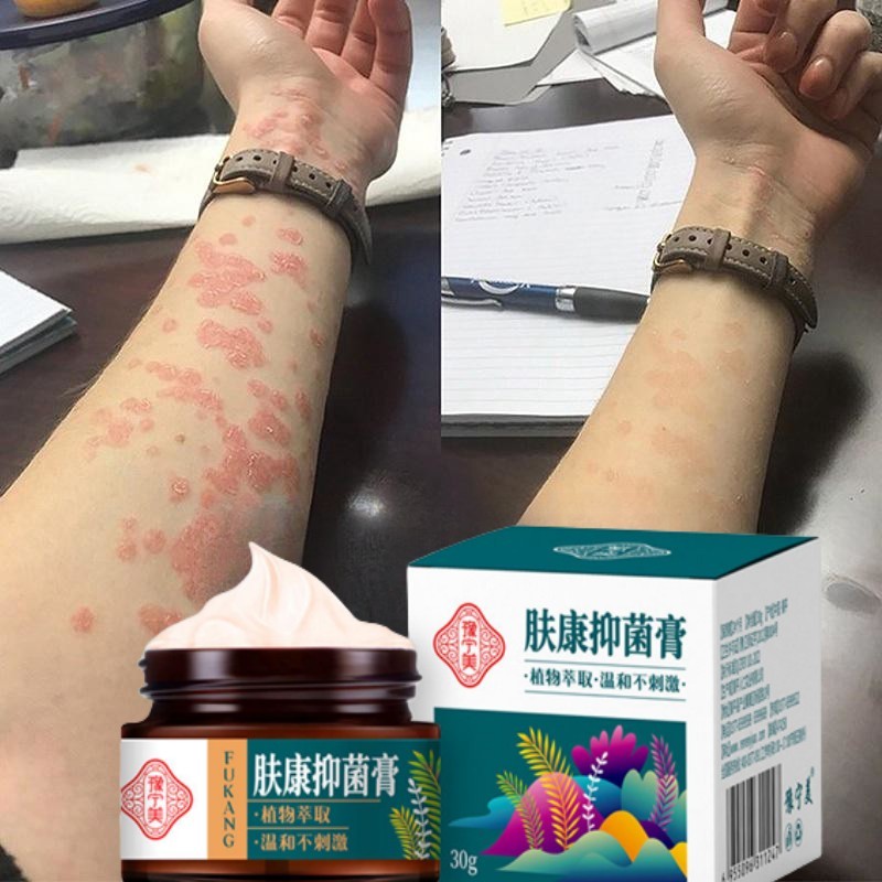 Salep Gatal Paling Ampuh Obat psoriasis salep eksim salap gatal kulit yang ampuh Salep Kulit Jamur