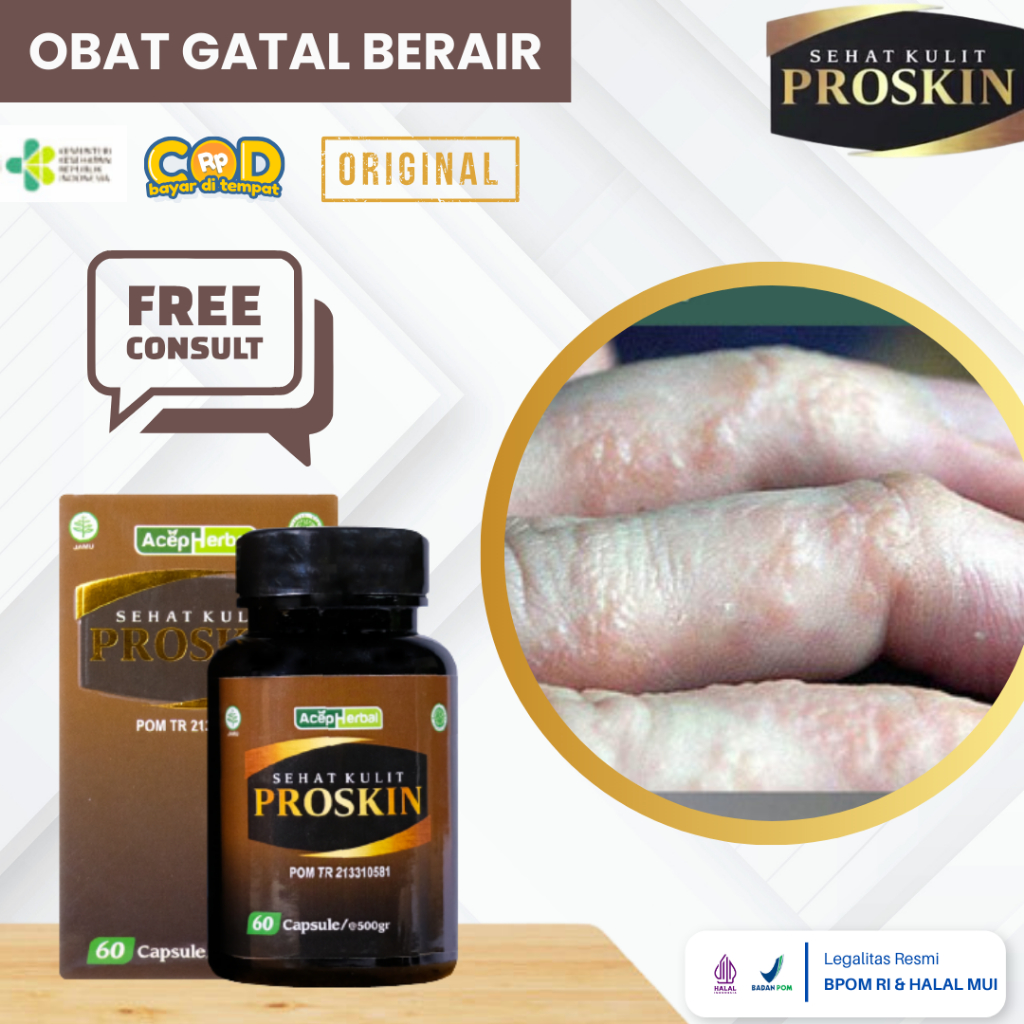 Obat Gatal Berair, Obat Gatal Berair Di Jari Tangan Dan Kaki, Obat Bintik Berair, Obat Kutu Air, Pen