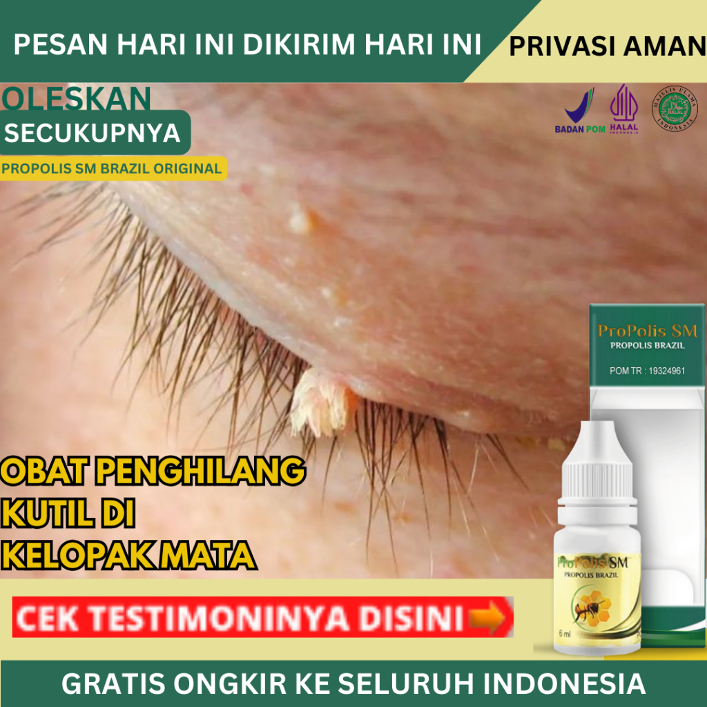 Obat Kutil Di Kelopak Mata, Obat Penghilang Papiloma HPV Di Wajah, Kutil Di Tangan, Pengempis Daging