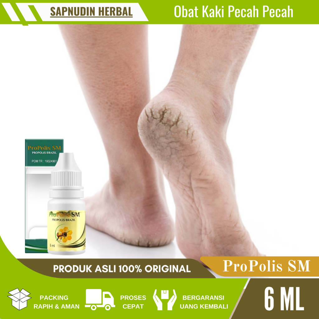 Obat Kaki Pecah Pecah Dan Kering Kasar, Obat Kaki Rayapan Dan Bau, Obat kaki Pecah Pecah, Obat kaki 