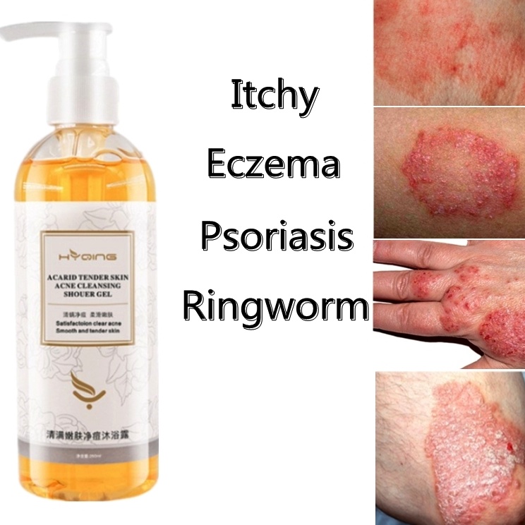Sekarang Dikirim  eczema body wash Pengobatan Eksim psoriasis eksim kering Kurap gatal kulit jamur k