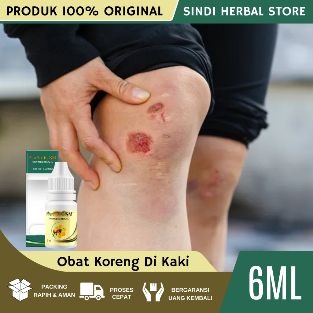 Obat Koreng Di Kaki, Obat Penghilang Bekas Koreng, Obat Bekas Luka Koreng, Obat Koreng, Penghilang B
