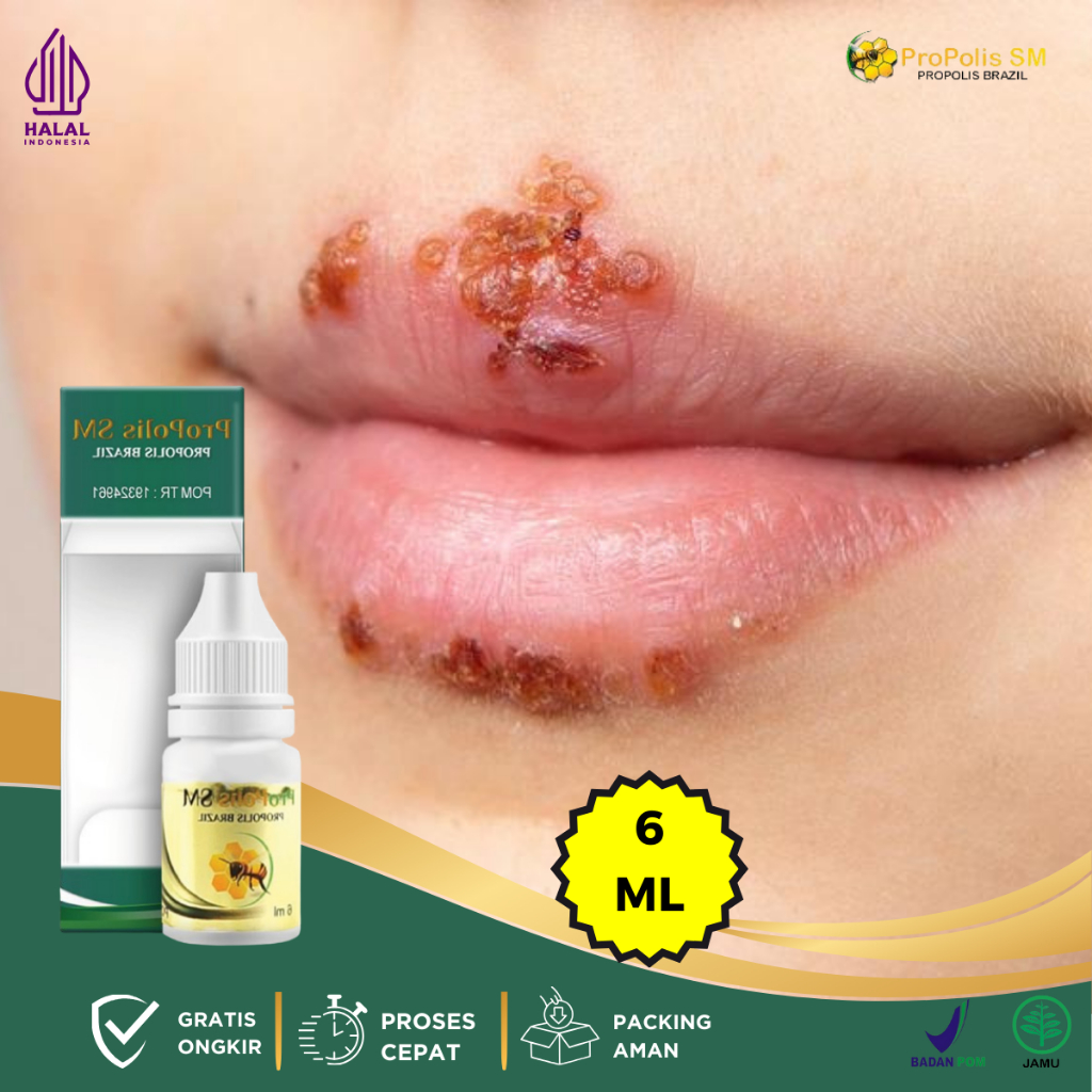 Obat Herpes Kulit Gatal Berair Menyebar, Obat Herpes Kulit, Obat Herpes Kelamin, Obat Herpes Bibir, 