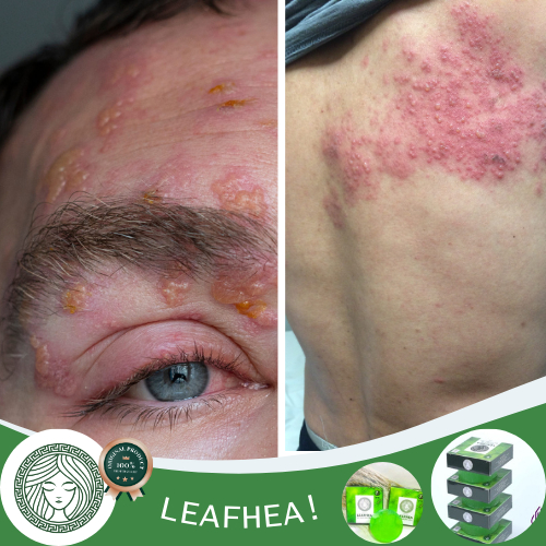Sabun Obat Herpes Zoster, Obat Herpes kulit, Obat herpes bibir, Obat herpes Genital / Herpes Kelamin