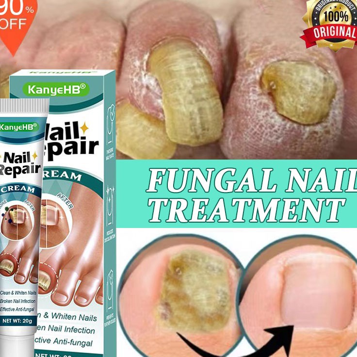 NEW PROMO Obat Jamur Kuku obat kuku jamur dan rusak obat jamur kuku lanbena 2g Obat cantengan obat K