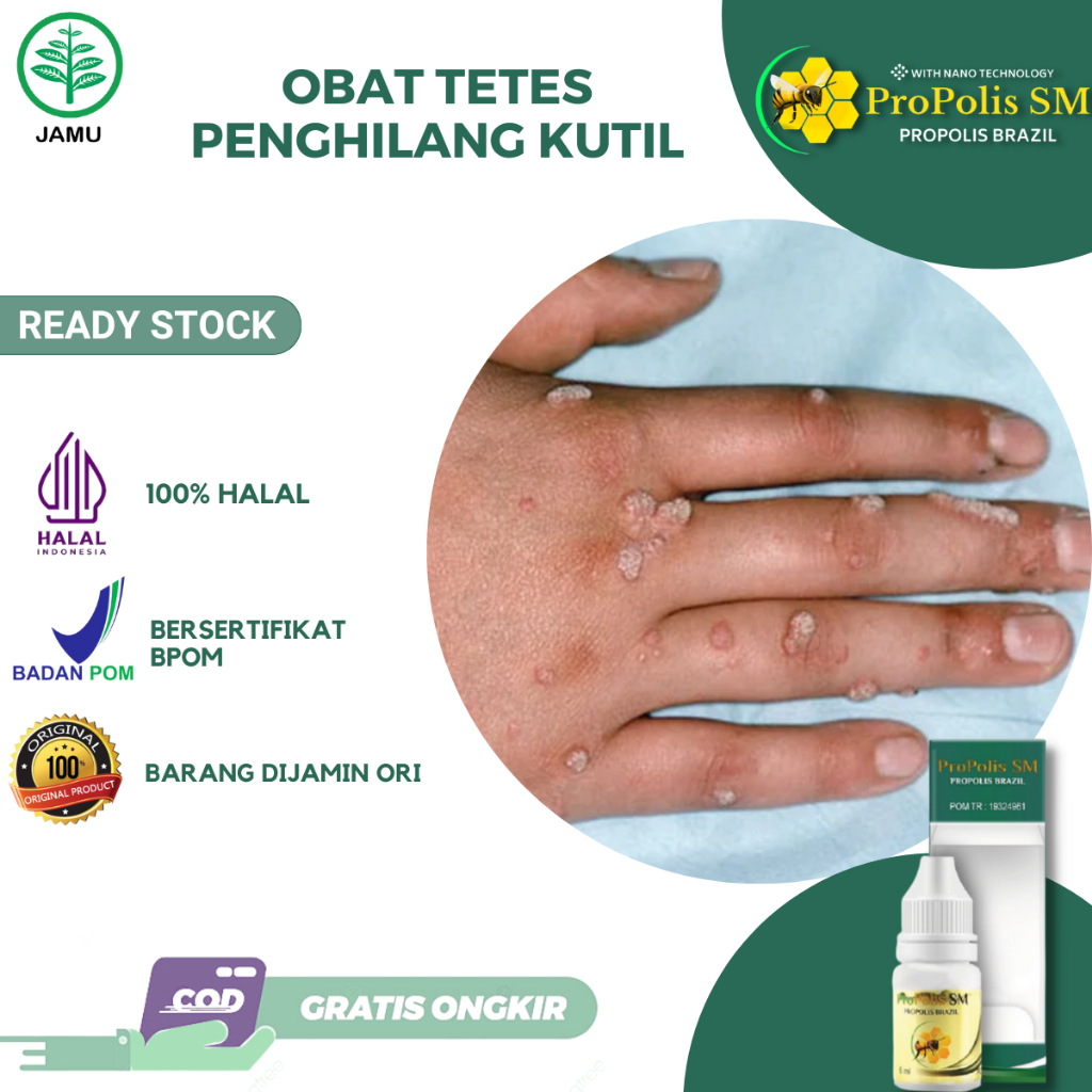 Obat Oles Penghilang Kutil Obat Kutil di Wajah Kutil di Leher Kutil di Ketiak Kutil di Tangan Kutil 