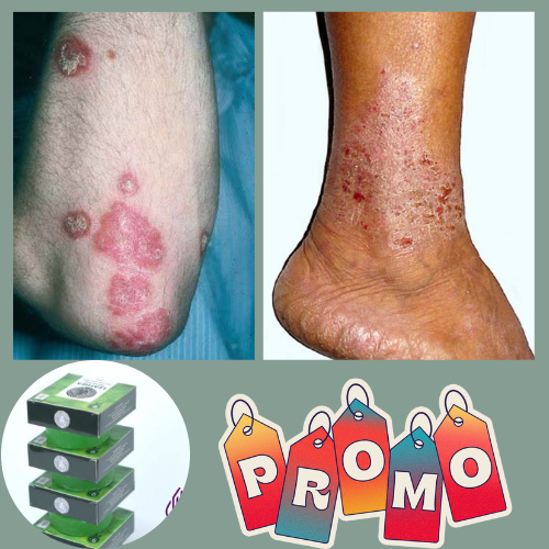 Salep Sabun Obat Gatal Eksim Exim Basah Kering Jamur Kulit Paling Ampuh Racikan Eksim Khusus Gatal E