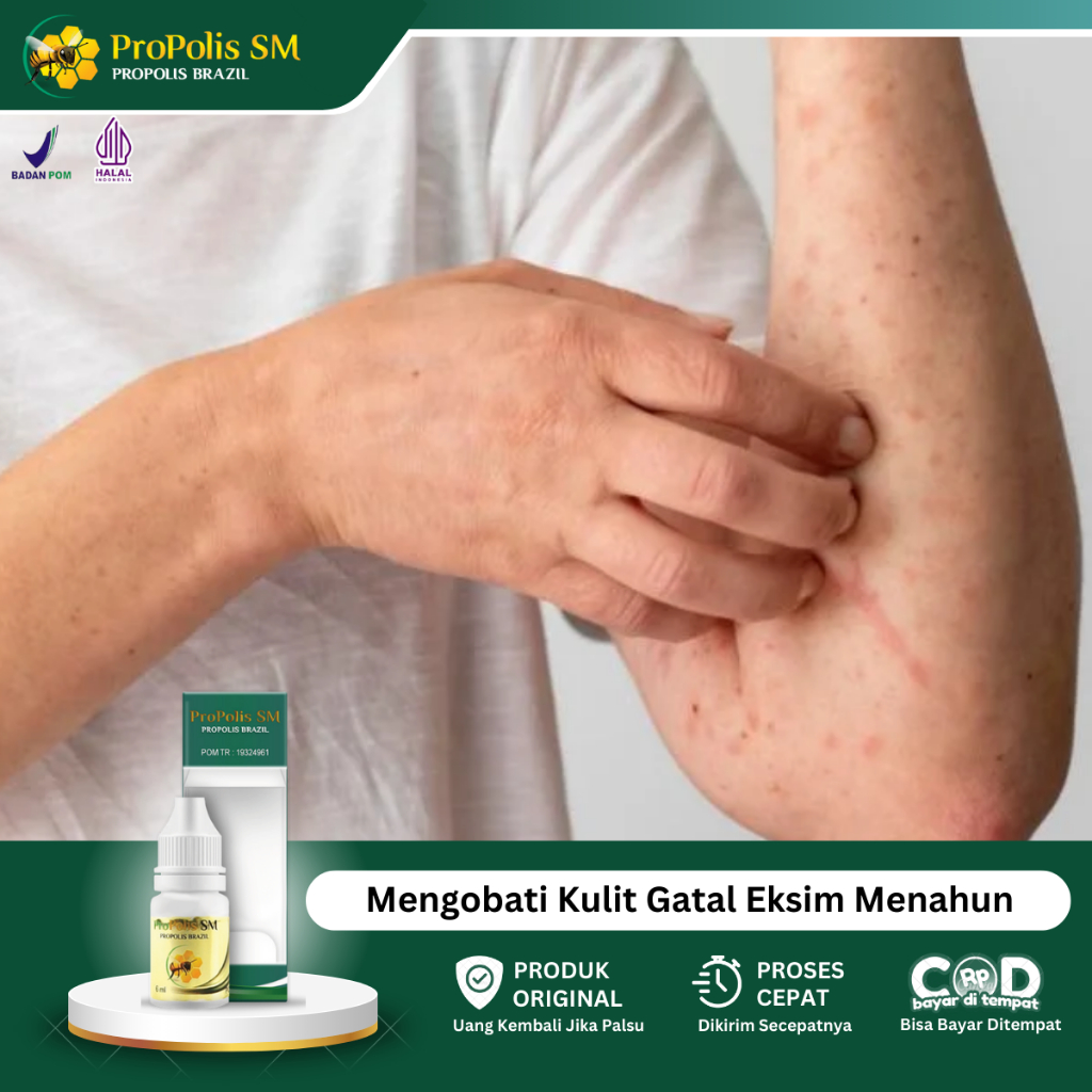 Obat Eksim Kering, Obat Gatal Kulit Eksim, Obat Kulit Bersisik, Obat Kudis, Obat Kulit Tebal Kering,